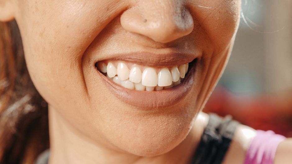 Veneers Erfahrungen 2026: Was Patienten wirklich berichten