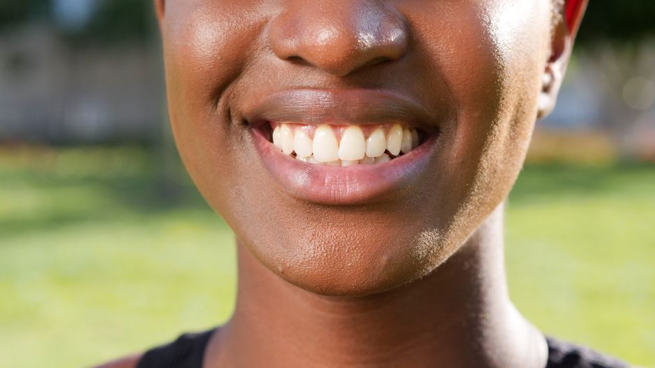 Veneers Türkei Erfahrungen 2026: Was Patienten wirklich berichten