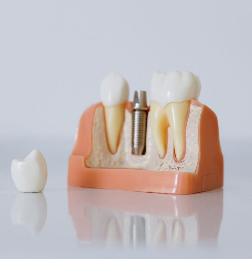 All on 4 Türkei: Vollständige Zähne für 4 Implantate – was dahinter steckt